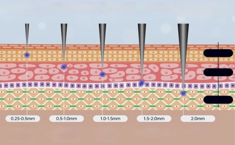 ANGEL KISS REGULOWANY STEMPEL MIKROIGŁOWY 120 TYTANOWYCH MIKROIGIEŁ