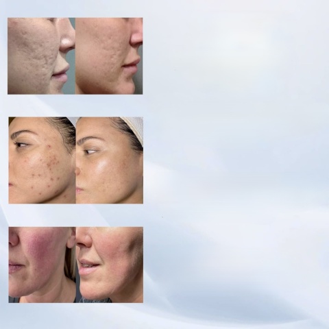 ANGEL KISS REGULOWANY STEMPEL MIKROIGŁOWY 120 TYTANOWYCH MIKROIGIEŁ